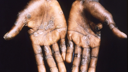 Latest company news about Monkeypox-Ausbruch wirft ‚moderates Risiko‘ zur Weltöffentlichkeitsgesundheit auf, sagt WHO